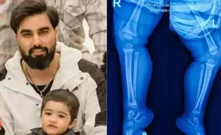 What is Rickets, Youtuber Armaan Malik’s Son Has Been Diagnosed With? Know How to Prevent It