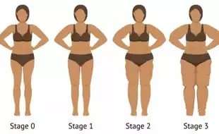 What is Lipedema And Why Are Most Indian Women More Susceptible To It?