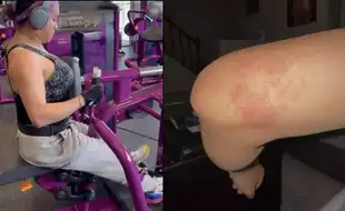 Gym Goer Picks Severe Ringworm Infection from the Equipment; Here's How You Can Protect Yourself
