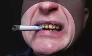 No Smoking Day 2025: This Is How Smoking Destroys Your Teeth—And It’s Not Just Stains!