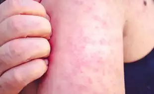 Michigan Reports First Case Of Measles, US Crosses 300 Cases—Are You At Risk?