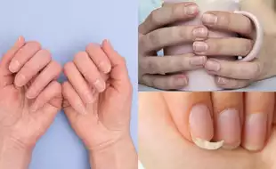 Changes In Your Nails That Could Be Sign of a Deadly Disease