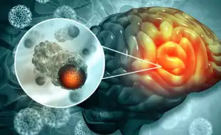 Coffee Addict Thought Nothing of Headaches, Brain Fog Until Her Aggressive Brain Cancer Diagnosis; Know Other Symptoms