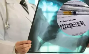 World TB Day 2025: India Accounts For 30 Percent Global Cases; Why Are The Tuberculosis Numbers So High?