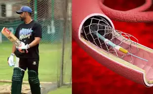 Tamim Iqbal, Former Bangladesh Cricket Captain, Underwent Angioplasty After Suffering A Heart Attack; We EXPLAIN Why It Is Done
