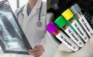 World Tuberculosis Day 2025:  When Is The Right Age To Get Tested For TB—Are You At Risk?