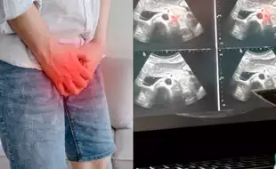 Micro-Ultrasound Shows MRI-Level Accuracy In Detecting Prostate Cancer