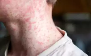 Kansas Reports Measles Outbreak With 23 Cases As Infections Rise Across US