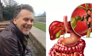 Fit and Healthy Lawyer Dies Just Weeks After Bile Rare Duct Cancer Diagnosis; Early Symptoms You Must Not Ignore