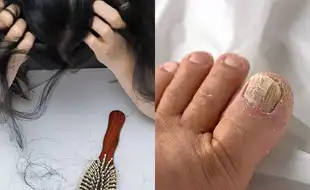 Are You Facing Extreme Hair Loss and Brittle Nails? You May Be Deficient In THIS Important Nutrient