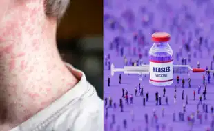 Texas Measles Outbreak Rises To Nearly 500 Cases As Virus Spreads Among Day Care Children