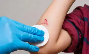 'Dettol Burns The Wound!' Dermatologist Says It Is NOT A Safe First-Aid Option