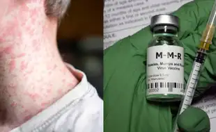Second Child Dies of Measles in Texas Even As Outbreak Continues