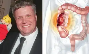 What is Colon Cancer Dennis the Menace Star Jay North Die Of? Know Early Signs to Spot It