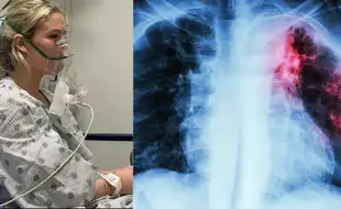 Popcorn Lung: Teenager Struggles To Breathe After Developing Rare Condition Due To Vaping Secretly