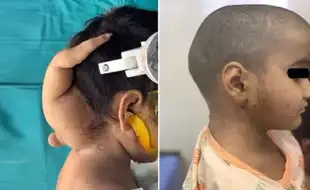 AIIMS Doctors Remove Rare Parasitic Twin From Toddler's Skull in a Complex Surgery; Know All About the Rare Condition