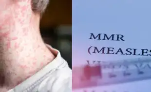 Five Dangerous Measles Myths To Know As US Cases Continue to Rise