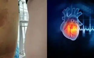 Man's Puffy Hangover Face Gets Diagnosed As Swollen Heart; Know The Symptoms of This Life-threatening Condition